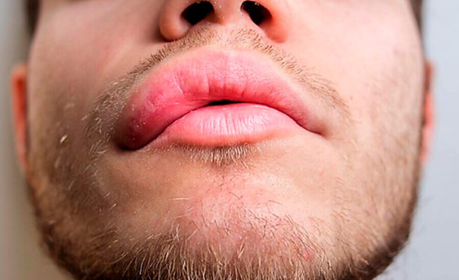 Angioedema Hereditário